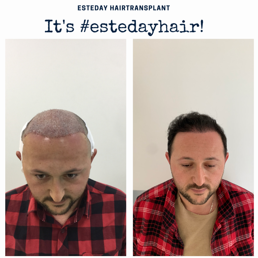 Esteday: Hair Transplant, Aesthetic Operations & Medical Aesthetic