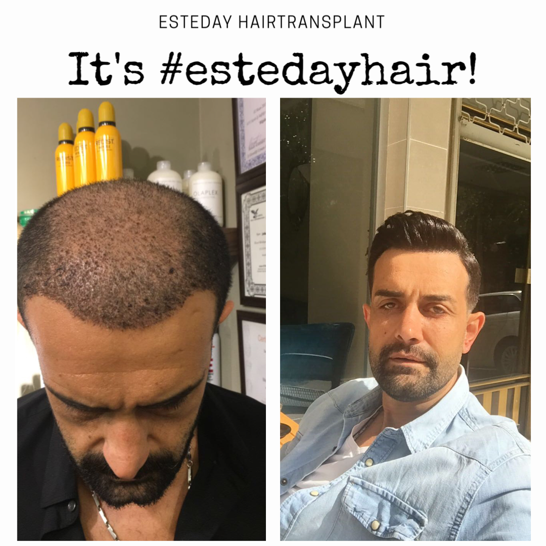 Esteday: Hair Transplant, Aesthetic Operations & Medical Aesthetic