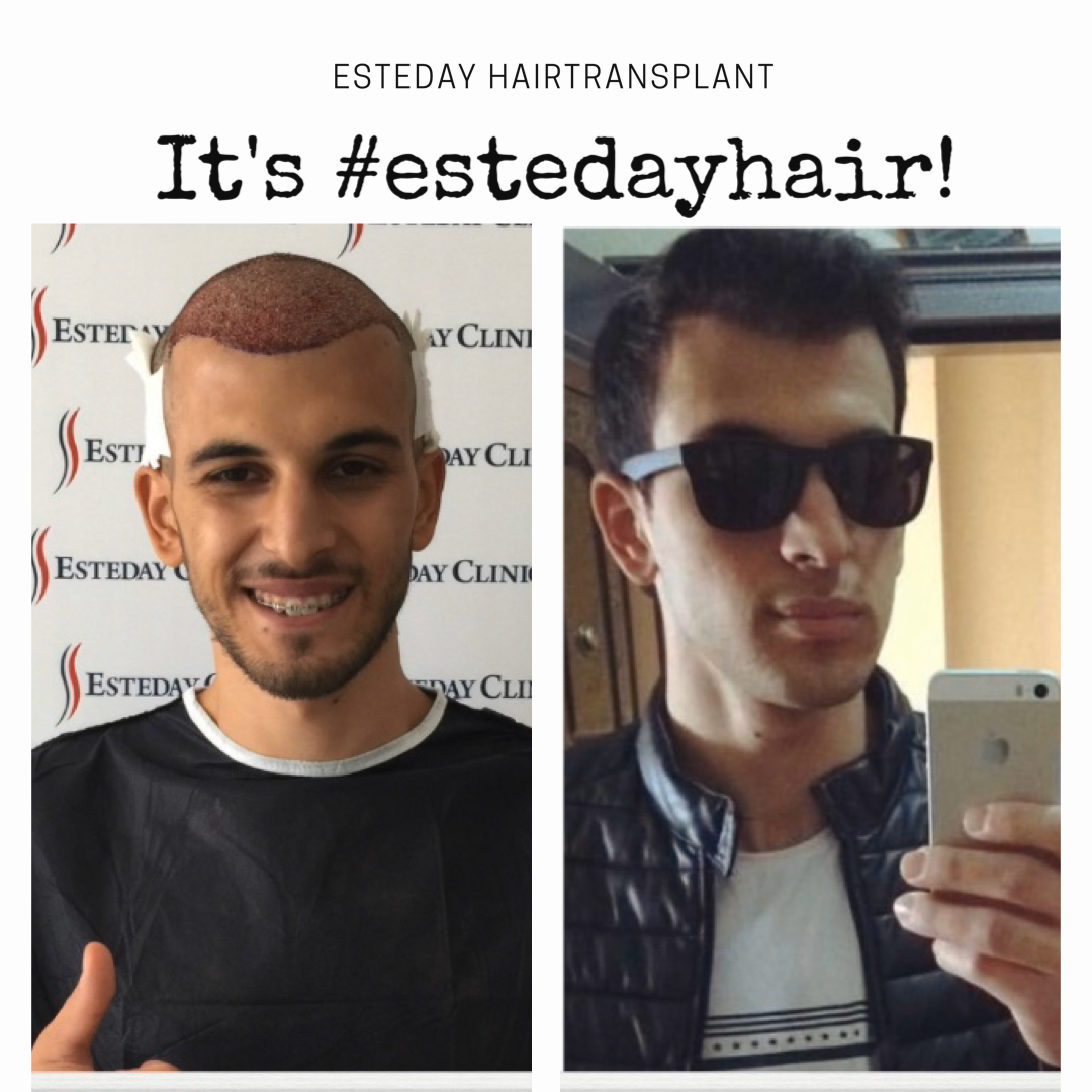 Esteday: Hair Transplant, Aesthetic Operations & Medical Aesthetic