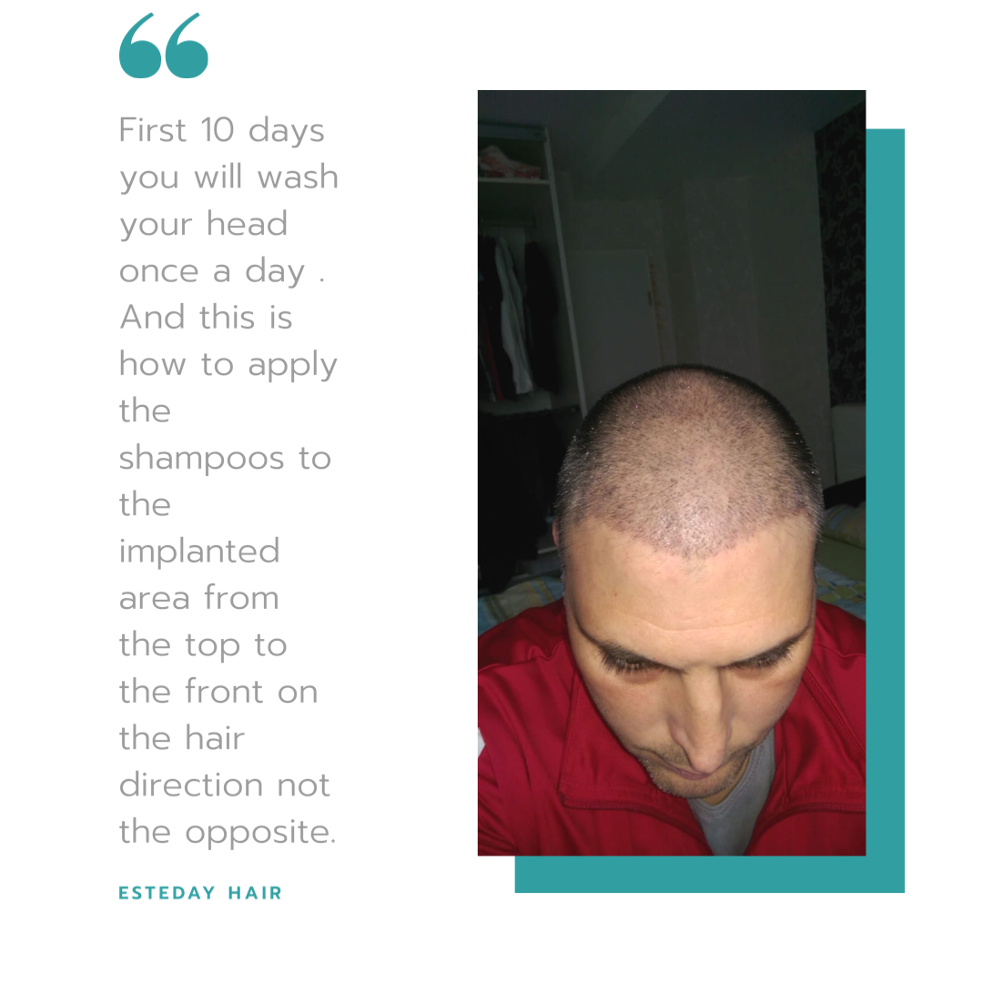 Esteday: Hair Transplant, Aesthetic Operations & Medical Aesthetic